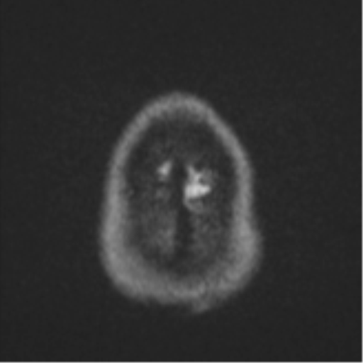 File:CNS vasculitis (Radiopaedia 55715-62263 Axial DWI 58).png