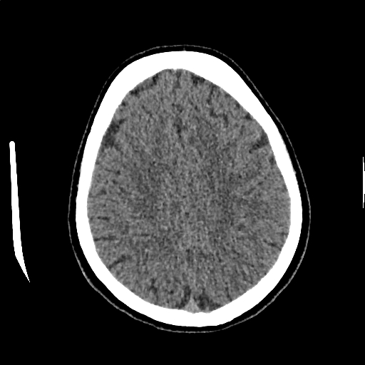 Calcified cerebral hydatid cyst (Radiopaedia 65603-74717 Axial non-contrast 56).jpg