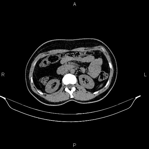 File:Calcified hepatic hydatid cyst (Radiopaedia 84672-100095 Axial non-contrast 44).jpg