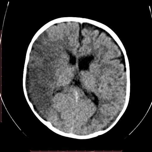 File:Calcified middle cerebral artery embolism (Radiopaedia 78949-91860 Axial non-contrast 15).jpg