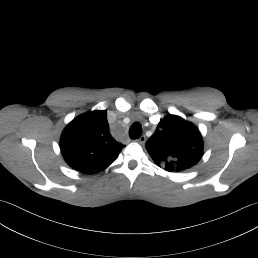 Cannonball metastases - testicular choriocarcinoma (Radiopaedia 84510-99891 B 30).jpg