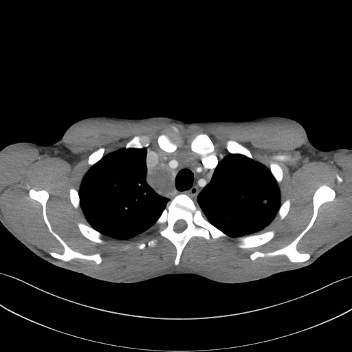 Cannonball metastases - testicular choriocarcinoma (Radiopaedia 84510-99891 B 31).jpg