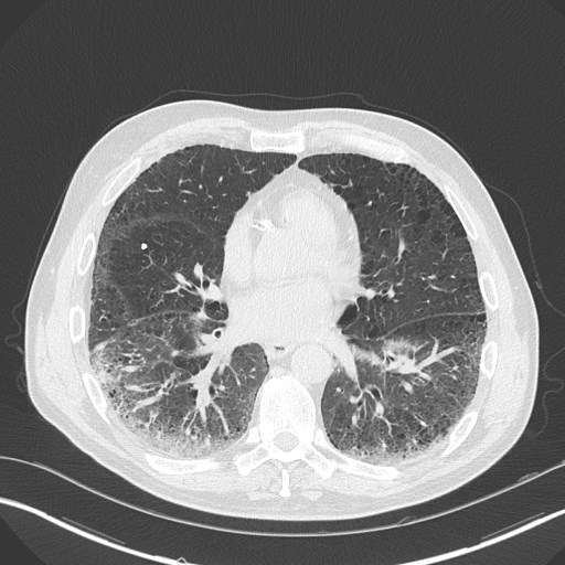Caplan syndrome (Radiopaedia 56667-63530 Axial lung window 121).jpg