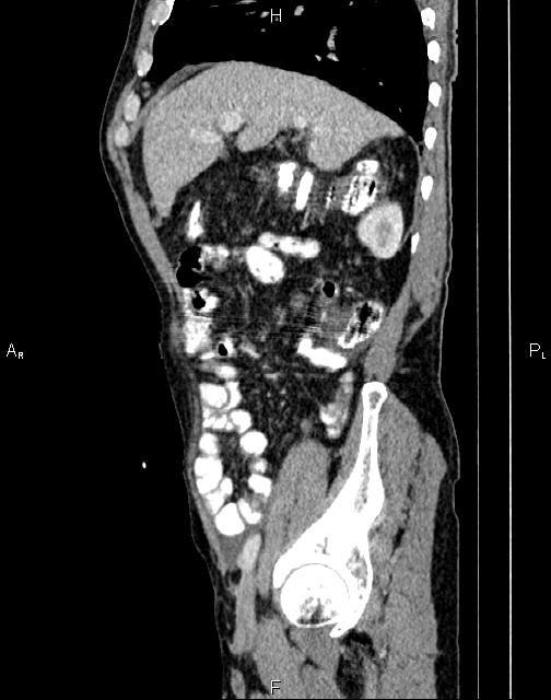 Caput medusae sign - portal hypertension (Radiopaedia 64007-72759 B 18).jpg