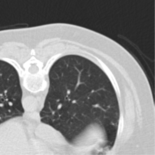 Carcinoid tumor - lung (Radiopaedia 44814-48644 Axial lung window 63).png