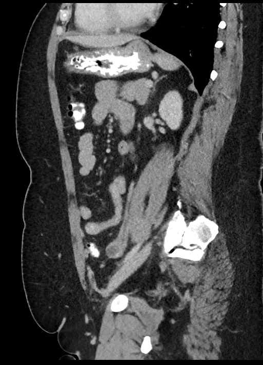 Carcinoid tumor - terminal ileum (Radiopaedia 60931-68739 C 32).jpg