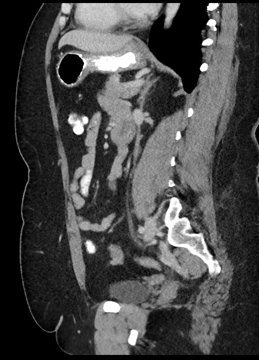 Carcinoid tumor - terminal ileum (Radiopaedia 60931-68739 C 37).jpg