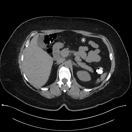 Carcinoid tumor - terminal ileum (Radiopaedia 60931-68740 Axial non-contrast 30).jpg