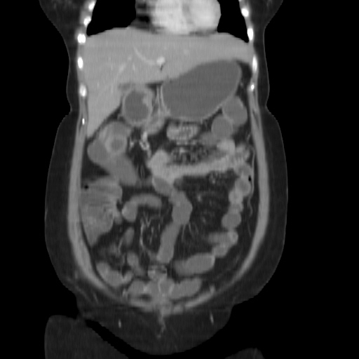 File:Carcinoma colon - hepatic flexure (Radiopaedia 19461-19493 B 10).jpg