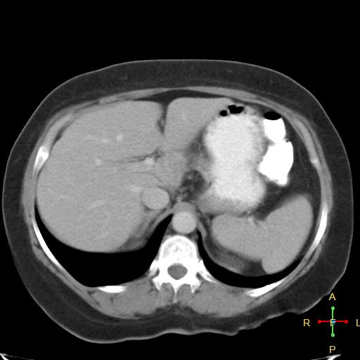 File:Carcinoma of sigmoid colon (Radiopaedia 23071-23100 B 4).jpg