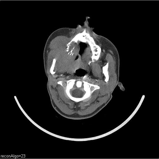 Carcinoma of the maxillary antrum (Radiopaedia 53805-59888 Axial C+ delayed 46).jpg