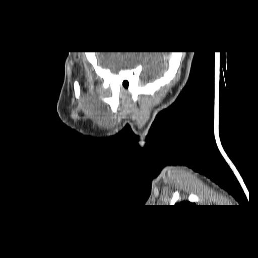 Carcinoma of the maxillary antrum (Radiopaedia 53805-59888 Sagittal C+ delayed 34).jpg