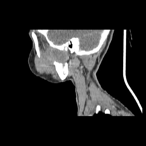 Carcinoma of the maxillary antrum (Radiopaedia 53805-59888 Sagittal C+ delayed 44).jpg
