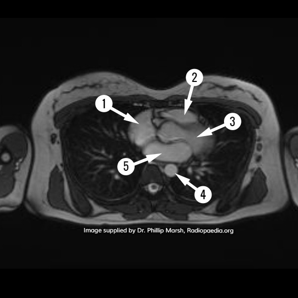File:Cardiac MRI - axial (anatomy quiz) (Radiopaedia 61145).jpg