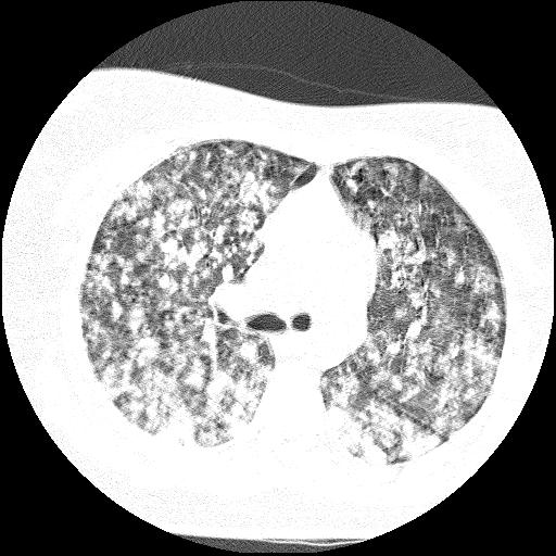 Cardiac angiosarcoma (Radiopaedia 66010-75181 Axial lung window 58).jpg