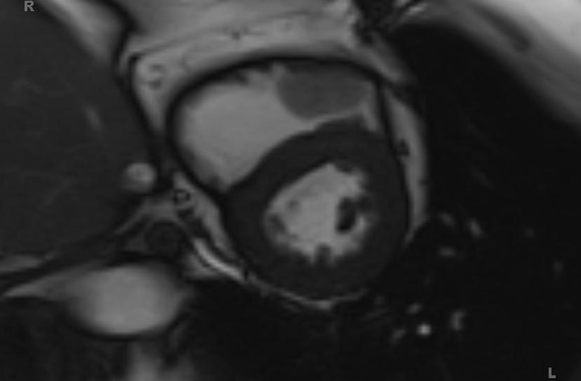 Cardiac hemangioma (Radiopaedia 31709-32631 Short axis Cine SSFP 47).jpg