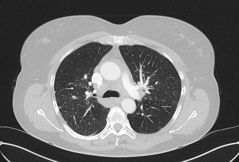 Cardiac sarcoidosis (Radiopaedia 74548-85534 Axial lung window 31).jpg