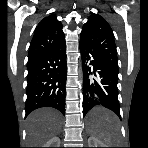 File:Cardiac tumor - undifferentiated pleomorphic sarcoma (Radiopaedia 45844-50134 Coronal non-contrast 50).png