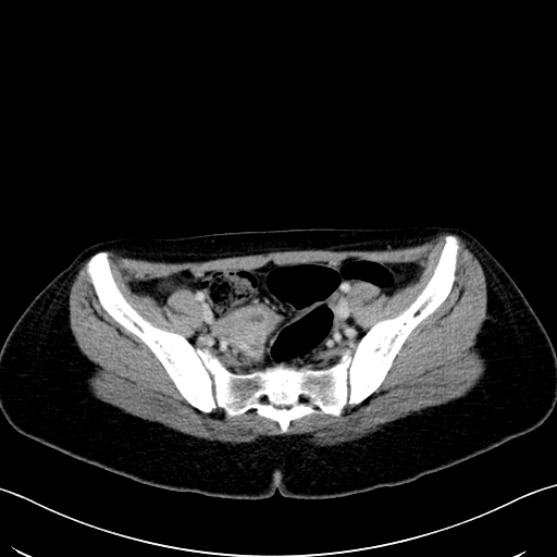 Caroli disease with medullary sponge kidney (Radiopaedia 82622-96804 C 61).jpg
