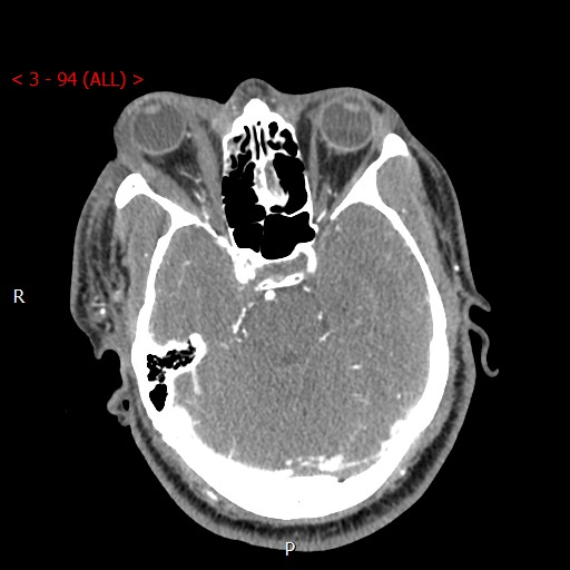 Caroticocavernous fistula (Radiopaedia 42346-45457 B 25).jpg