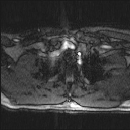 Carotid artery dissection (Radiopaedia 28441-28689 Axial MRA 5).jpg