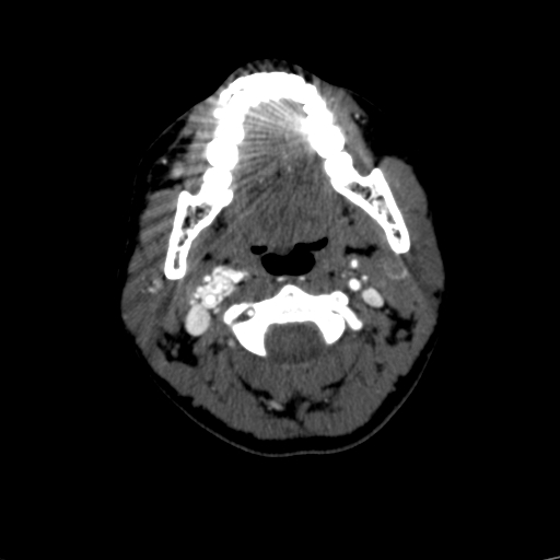 File:Carotid body tumor (Radiopaedia 39845-42300 B 52).jpg