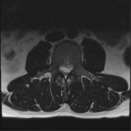File:Cauda equina syndrome (Radiopaedia 53615-59672 Axial T2 23).png