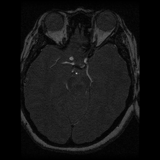 Cavernoma, DVA and right ICA aneurysm (Radiopaedia 33890-35072 E 50).png