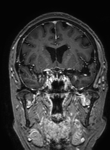 Cavernous hemangioma of the cerebellar falx (Radiopaedia 73025-83724 Coronal T1 C+ 152).jpg