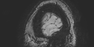 Cavernous hemangioma of the cerebellar falx (Radiopaedia 73025-83724 Sagittal BOLD 196).jpg