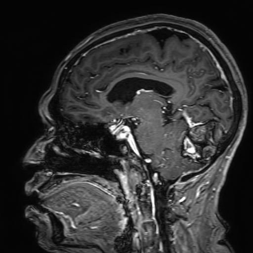 File:Cavernous hemangioma of the cerebellar falx (Radiopaedia 73025-83724 Sagittal T1 C+ 117).jpg