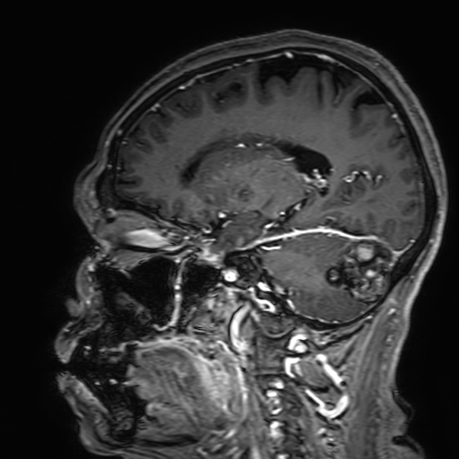 Cavernous hemangioma of the cerebellar falx (Radiopaedia 73025-83724 Sagittal T1 C+ 133).jpg