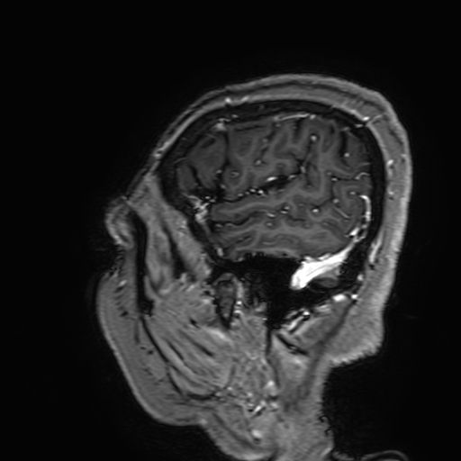 Cavernous hemangioma of the cerebellar falx (Radiopaedia 73025-83724 Sagittal T1 C+ 183).jpg
