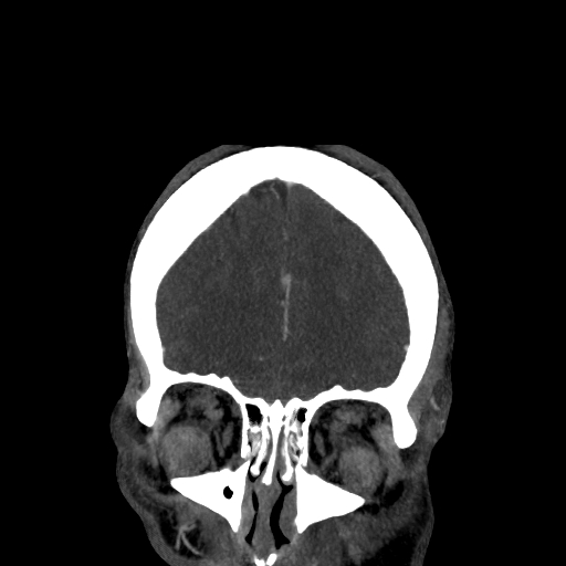 File:Cavernous sinus thrombosis (Radiopaedia 10619-11078 D 2).jpg