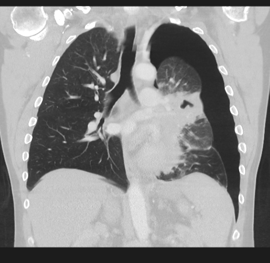 Cavitating pneumonia complicated by pneumothorax (Radiopaedia 48149-52994 Coronal lung window 33).png