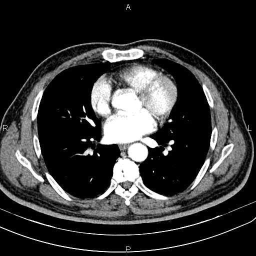 File:Cecal cancer with appendiceal mucocele (Radiopaedia 91080-108651 A 39).jpg