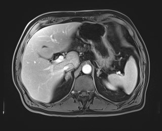 Cecal mass causing appendicitis (Radiopaedia 59207-66532 T1 C+ PV phase 40).jpg