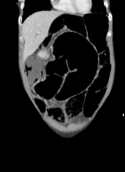 Cecal volvulus with pneumatosis coli (Radiopaedia 68572-78178 B 55).jpg