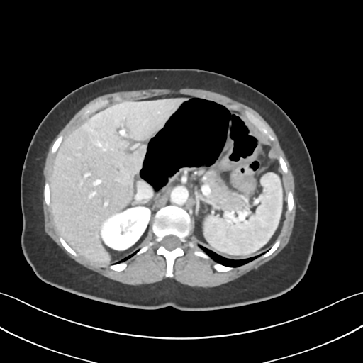 Cecum hernia through the foramen of Winslow (Radiopaedia 46634-51112 A 19).png