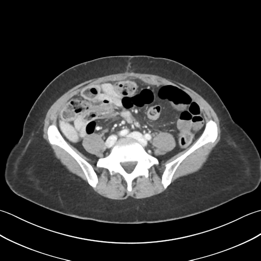 Cecum hernia through the foramen of Winslow (Radiopaedia 46634-51112 A 46).png