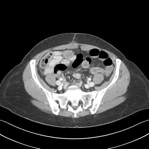 File:Cecum hernia through the foramen of Winslow (Radiopaedia 46634-51112 A 52).png