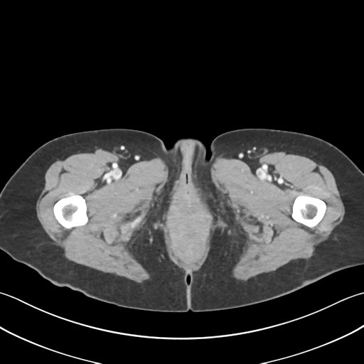 Cecum hernia through the foramen of Winslow (Radiopaedia 46634-51112 A 83).png
