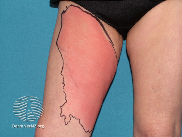 File:Cellulitis affects people of all ages and races. Predispositions to cellulitis include- (DermNet NZ bacterial-cellulitis4).jpg