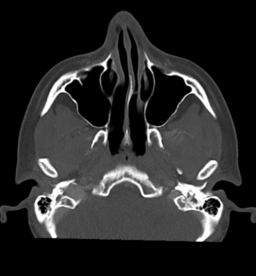 Cemento-ossifying fibroma (Radiopaedia 46243-50643 Axial bone window 26).png