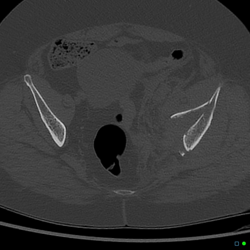File:Central fracture-dislocation of the acetabulum (Radiopaedia 36578-38150 Axial bone window 41).jpg
