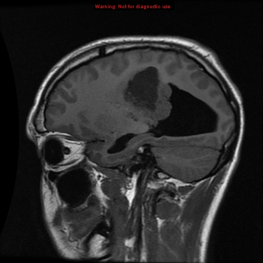 File:Central neurocytoma (Radiopaedia 13188-13206 Sagittal T1 3).jpg