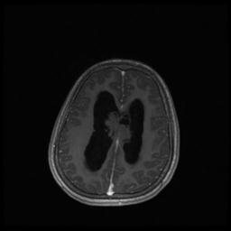 Central neurocytoma (Radiopaedia 30220-30842 Axial T1 C+ 106).jpg