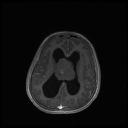 Central neurocytoma (Radiopaedia 30220-30842 Axial T1 C+ 94).jpg