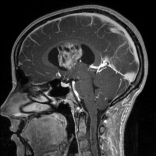 File:Central neurocytoma (Radiopaedia 37664-39557 Axial T1 C+ 79).png