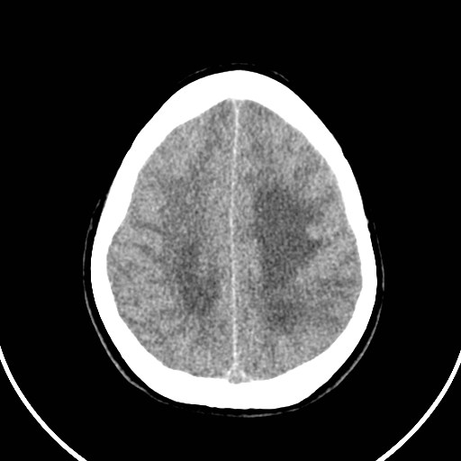 Central neurocytoma (Radiopaedia 84497-99871 Axial non-contrast 40).jpg